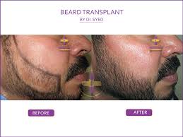 At our clinic, the trend is similar in that facial hair transplant constitutes about 5% of our. Best Beard Transplant In Gurgaon South Delhi Facial Hair Dr Syed