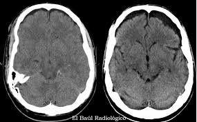 Cuando pasemos por varias salas dentro del hotel tomaremos un ascensor hasta el nivel más bajo del edificio. El Baul Radiologico 2 Edema Citotoxico En El Sistema Nervioso Central Citotoxic Edema In The Central Nervous System By Luis Mazas Artasona