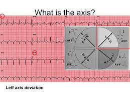 Ecg Presentation Slide 1 Qrs Axis Interactive Presentation Medical Knowledge Presentation Slides