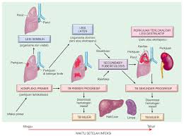 Usually found in the lungs but can also live in any part of the body. Tuberkulosis Tb Patofisiologi Diagnosis Tatalaksana Kedokteran Caiherang