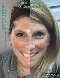 Neora's Neo-FILLER is delivering remarkable results once again! With  consistent daily use over just 5–9 weeks, the transformation speaks for  itself. While individual results may vary, many users experience visible,  noticeable improvements—especially