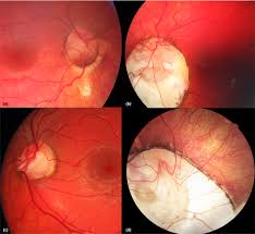 Image result for Coloboma