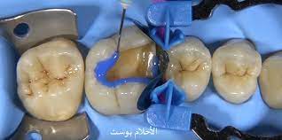 علاج تسوس الاسنان للأطفال والكبار بالأعشاب الطبيعية والليزر نهائيا الاحلام بوست