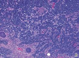 Merkell cell carcinoma is also known as neuroendocrine carcinoma or primary skin cell carcinoma, a high form of a rare skin cancer. Merkel Cell Carcinoma A Review Mdedge Dermatology