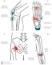 Image result for Hip Apophysitis