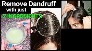 Do not oil hair and keep it on for long. Magical Home Remedy To Remove Dandruff At Home Dandruff Treatment How To Get Rid Of Dandruff Youtube