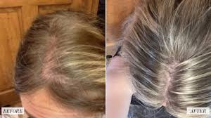 Hair loss is caused by a variety of factors in women and men. An Allure Reader Shares How Viviscal S Hair Growth Supplements Transformed Her Hair Before And After Photos Allure
