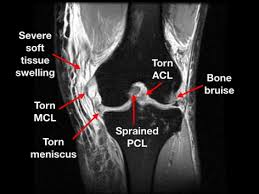 The images may also help physicians to distinguish normal, healthy tissues from dead tissues(2). Multi Ligament Knee Injuries Sterling Ridge Orthopaedics Sports Medicine