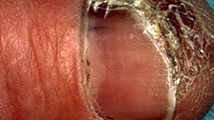 What does toenail fungus look like? Subungual Melanoma Symptoms Causes And Treatments