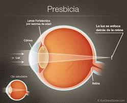 Image result for Presbyopia