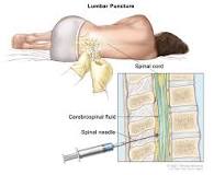 Image result for icd 10 code for myeloid leukemia