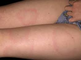 De fait, le diagnostic de la maladie de lyme dépend à la fois du résultat des tests et de la présence de signes typiques. Maladie De Lyme Infections Manuels Msd Pour Le Grand Public