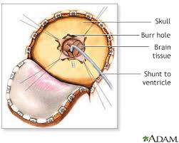 Ventriculoperitoneal Shunting Information Mount Sinai New York