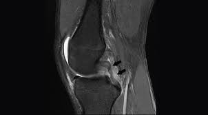 Accessory muscles of the knee john f. Racgp Imaging Of The Knee