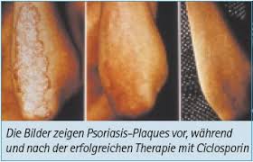 Ciclosporin is believed to elicit its effects by directly binding to the cyclophilin d protein (cypd) that constitutes part ciclosporin — strukturformel allgemeines freiname ciclosporin andere namen … Deutsche Haut Und Allergiehilfe E V Haut Allergie Aktuell