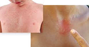 Image result for contact dermatitis