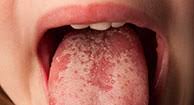 Sensitive + enamel shield, cph healthy fresh Tongue Problems Symptoms Causes Diagnosis Treatment