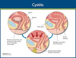 Cystitis Nursing Care And Management Study Guide Cystitis Yeast Infection Treatment Yeast Infection