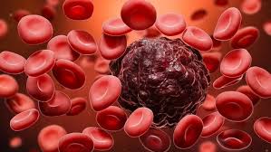Bệnh ung thư m&aacute;u: Dấu hiệu, triệu chứng v&agrave; nguy&ecirc;n nh&acirc;n l&agrave; g&igrave;? | Genetica&reg;