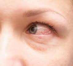 Cat litter, dog litter, ice melter, wild bird food; Allergic Conjunctivitis Treatment Symptoms And Causes