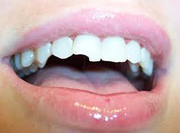 Egal Ob Ein Backenzahn Oder Ein Schneidezahn Abgebrochen Ist Den Zahnarzt Sollten Sie Auf Alle Falle Aufsuchen Dentalnews