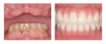 Image result for dentures