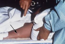 The virus, which causes middle east respiratory syndrome (mers), is a novel coronavirus that was first identified in a patient from jeddah, saudi arabia on june 6, 2012. Marburg Virus Skin Rash 2 Doccheck