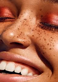 Image result for Freckled skin