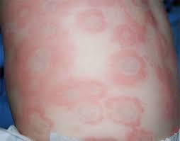 Allergic Reaction Rash Home Remedies Natural Health Bag In 2021 Allergic Reaction Rash Allergic Reaction Remedies Rashes Remedies