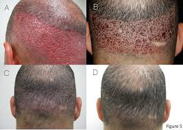 You will need to get a consultation with a bosley doctor in order to get a better idea for yourself, otherwise it will just be a guess. Atlanta How Much Hair Loss Is Normal Female 7 Practical Tips To Restore Your Hair