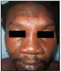 Suspicion of borderline leprosy with type 1 reversal reaction,...