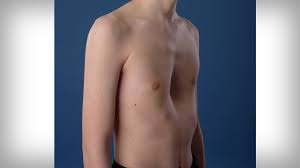 Check spelling or type a new query. Amsterdam Umc Locatie Amc Pectus Excavatum