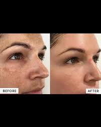 I heard you're in need of a skin refresh? 🫧🗓️🧖🏼‍♀️ Chemical peels