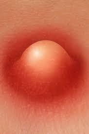 Boils On The Inner Thigh: Symptoms, Causes, And Treatment