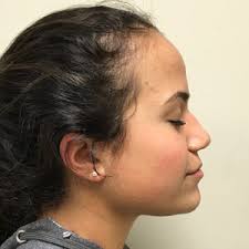 Liquid Rhinoplasty Before and After Photos