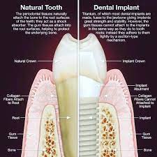 Ma Gabriela Morales On Instagram Natural Tooth Vs Dental Implant Dentistry Implant Periodontics Periodoncia Implantes Dentarios Implante Dental Dentario