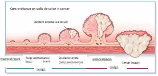 Trebuie sa stiti ca pentru a limita cresterea polipilor in volum pur si simplu trebuie sa ii curatati nasul copilului zilnic si corect. Am Polipi Pe Colon Ce Fac Mai Departe Reginamaria Ro