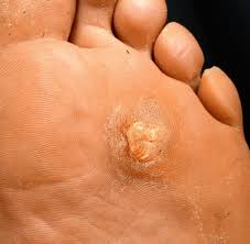 Die hautwucherungen finden sich vorwiegend an den fingern, im gesicht und unter der nagelplatte. Lastige Wucherungen Wie Warzen Entstehen Und Was Dagegen Hilft Welt