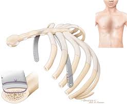 We wrote all informattions about pectus excavtum. Original Bar Fixation Technique In Minimally Invasive Repair Of Pectus Excavatum In Adolescents A 36 Case Series Sciencedirect