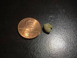 Both of them are two different problems. Felt Something Stuck In My Throat For A Week Finally Popped This Tonsil Stone Out This Morning Penny For Scale Popping