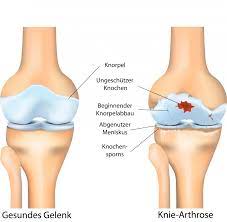 Stammzellen Behandlung Fur Arthrose Arthritis Anova Irm
