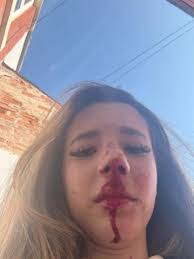 Blackburn girl, 13, left with broken nose in filmed attack