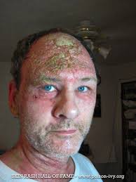 A Serious Poison Ivy Face Rash