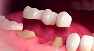 Dental Bridges A Complete Overview