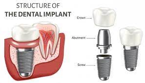 When can i start drinking coffee after wisdom tooth extraction? Houston Prosthodontics Implant Dentistry