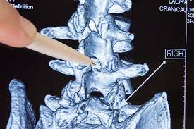 Spinalkanalstenose Symptome Therapien