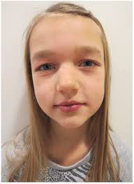 Cutaneous Expression of Familial Cancer Syndromes