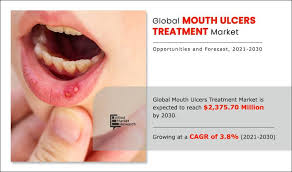 Image result for mouth ulcer on tongue)