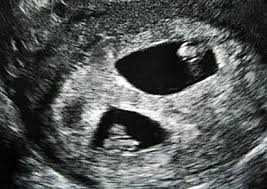 Eineiige Oder Zweieiige Zwillinge Babywelten Ch