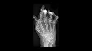 Gut Bacteria May Cause Rheumatoid Arthritis Science Aaas